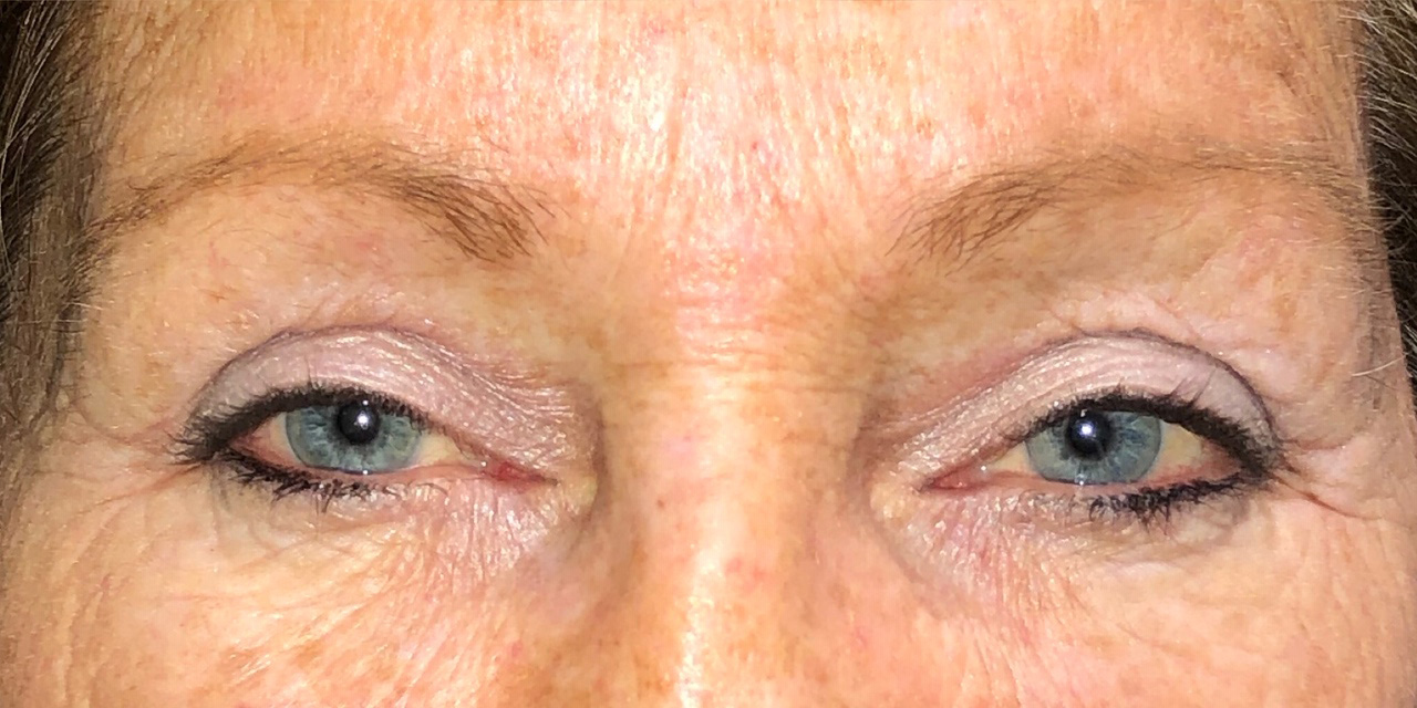 eyelid surgery philadelphia eyelids